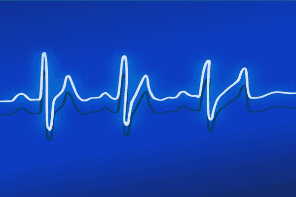 Electrocardiograms QRS Peak and Heart Rate detection Using DWT in Matlab