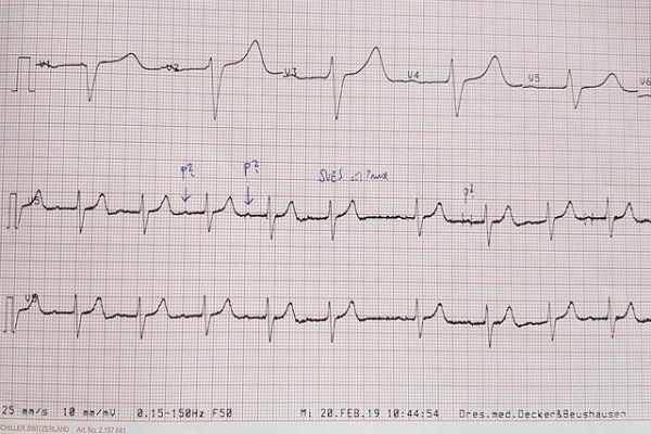 How to Classify ECG Signals Using Continuous Wavelet Transform and AlexNet